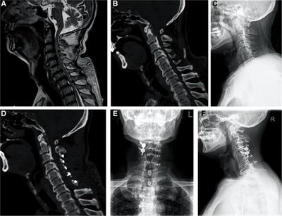 Cervical single open-door laminoplasty with or without local lateral mass screw fixation and fusion to treat cervical spinal cord injuries accompanied by segmental spinal canal stenosis